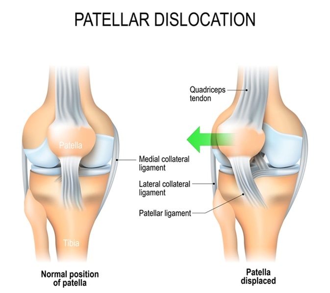 Gambaran dislokasi patella
