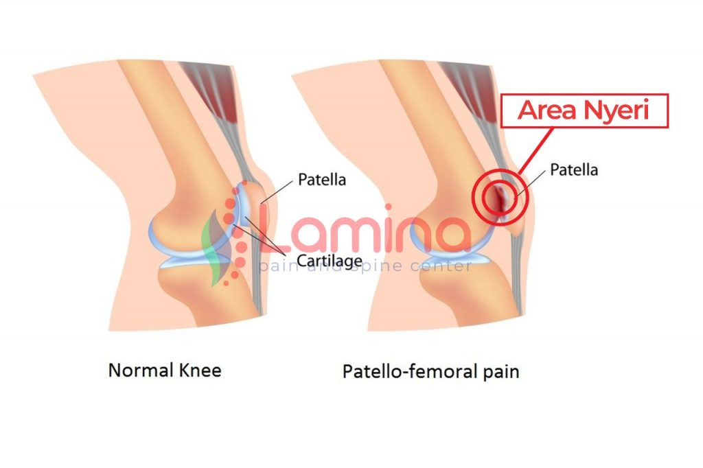 patellofemoral pain syndrome lutut nyeri