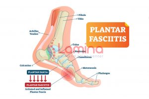 plantar fasciitis apa bisa sembuh sendiri