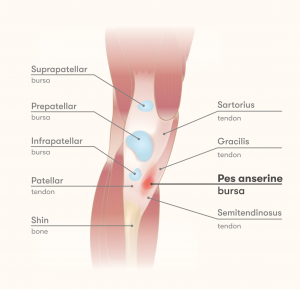 pes anserinus bursitis