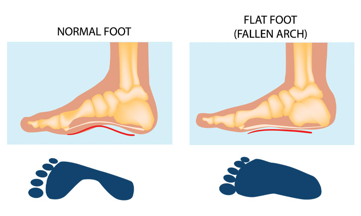 tanda kelainan tulang kaki