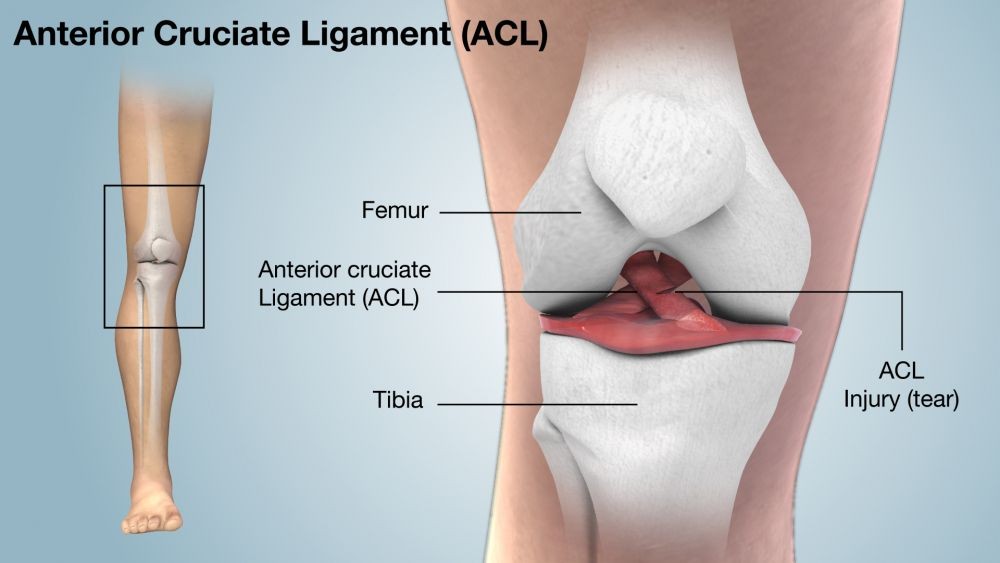 Gambar Cedera ACL - Patella