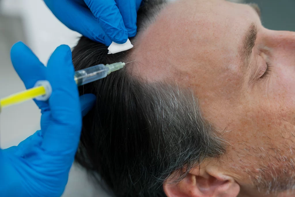 Solusi Tepat Rambut Rontok dengan Terapi PRP - Patella